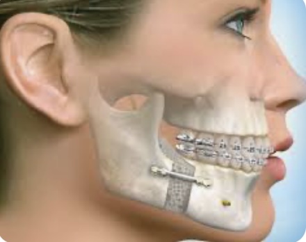 kinésithérapeute chirurgie orthognatique