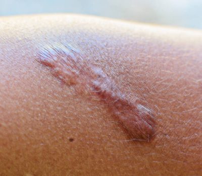 kinésithérapeute cicatrices